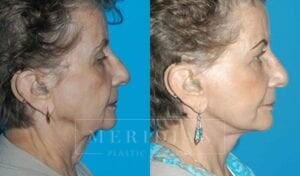 tjelmeland-meridian-austin-facelift-patient-5-2