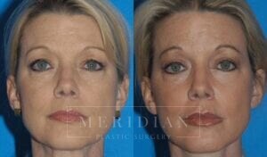 tjelmeland-meridian-austin-facelift-patient-6-1