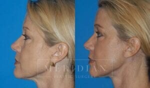 tjelmeland-meridian-austin-facelift-patient-6-2