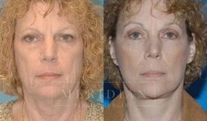 tjelmeland-meridian-austin-facelift-patient-7-1