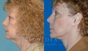 tjelmeland-meridian-austin-facelift-patient-7-2