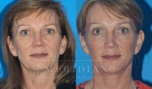 tjelmeland-meridian-austin-facelift-patient-8-1