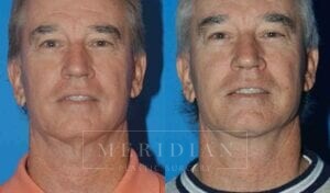 tjelmeland-meridian-austin-facelift-patient-9-1