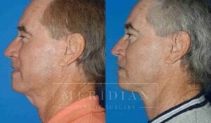 tjelmeland-meridian-austin-facelift-patient-9-2