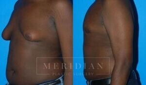 tjelmeland-meridian-austin-gynecomastia-patient-1-2