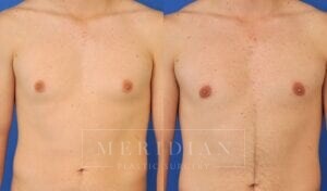 tjelmeland-meridian-austin-gynecomastia-patient-2-1