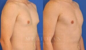 tjelmeland-meridian-austin-gynecomastia-patient-2-2