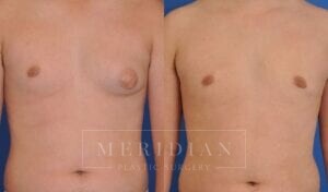 tjelmeland-meridian-austin-gynecomastia-patient-6-1