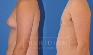 tjelmeland-meridian-austin-gynecomastia-patient-6-2