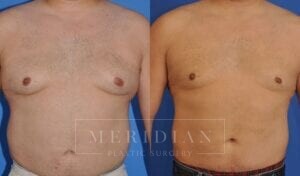 tjelmeland-meridian-austin-gynecomastia-patient-7-1