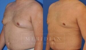 tjelmeland-meridian-austin-gynecomastia-patient-7-2