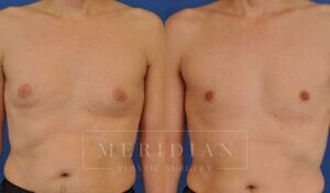 tjelmeland-meridian-austin-gynecomastia-patient-8-1