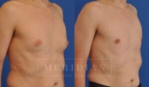 tjelmeland-meridian-austin-gynecomastia-patient-8-2