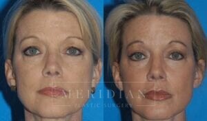 tjelmeland-meridian-austin-injectable-fillers-patient-1-1