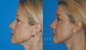 tjelmeland-meridian-austin-injectable-fillers-patient-1-2