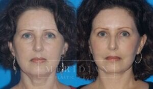 tjelmeland-meridian-austin-injectable-fillers-patient-2-1