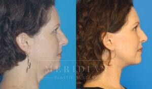 tjelmeland-meridian-austin-injectable-fillers-patient-2-2