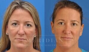 tjelmeland-meridian-austin-injectable-fillers-patient-3-1