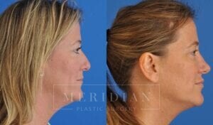 tjelmeland-meridian-austin-injectable-fillers-patient-3-2