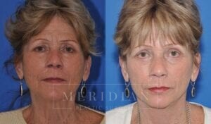 tjelmeland-meridian-austin-injectable-fillers-patient-4-1