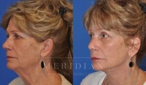 tjelmeland-meridian-austin-injectable-fillers-patient-4-2