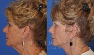 tjelmeland-meridian-austin-injectable-fillers-patient-4-3