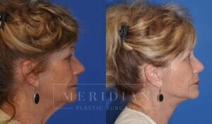 tjelmeland-meridian-austin-injectable-fillers-patient-4-4