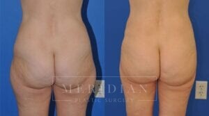 tjelmeland-meridian-austin-liposuction-patient-1-3