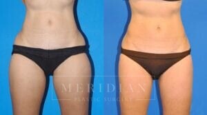 tjelmeland-meridian-austin-liposuction-patient-14-1