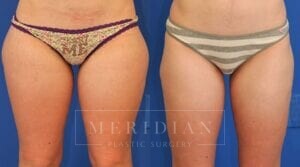 tjelmeland-meridian-austin-liposuction-patient-2-1