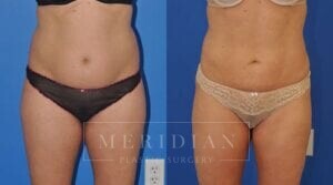 tjelmeland-meridian-austin-liposuction-patient-3-1