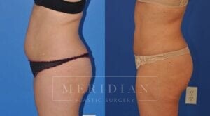 tjelmeland-meridian-austin-liposuction-patient-3-2