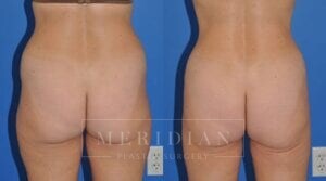 tjelmeland-meridian-austin-liposuction-patient-5-2