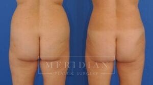 tjelmeland-meridian-austin-liposuction-patient-6-2