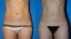 tjelmeland-meridian-austin-liposuction-patient-7-1