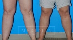 tjelmeland-meridian-austin-liposuction-patient-8-1