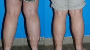 tjelmeland-meridian-austin-liposuction-patient-8-2