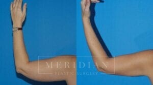 tjelmeland-meridian-austin-liposuction-patient-9-2