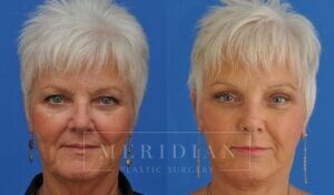 tjelmeland-meridian-austin-neck-lift-patient-1-1