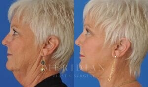 tjelmeland-meridian-austin-neck-lift-patient-1-2