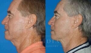 tjelmeland-meridian-austin-neck-lift-patient-3-2