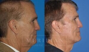 tjelmeland-meridian-austin-neck-lift-patient-4-2