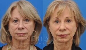 tjelmeland-meridian-austin-neck-lift-patient-6-1