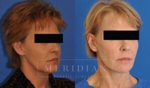 tjelmeland-meridian-austin-neck-lift-patient-7-2