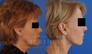 tjelmeland-meridian-austin-neck-lift-patient-7-3