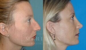 tjelmeland-meridian-austin-rhinoplasty-patient-1-1