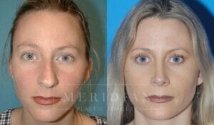 tjelmeland-meridian-austin-rhinoplasty-patient-1-2