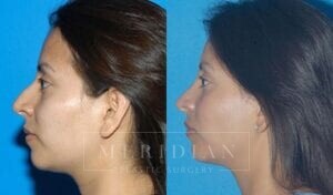 tjelmeland-meridian-austin-rhinoplasty-patient-2-1