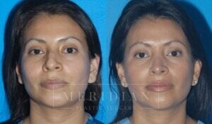 tjelmeland-meridian-austin-rhinoplasty-patient-2-2