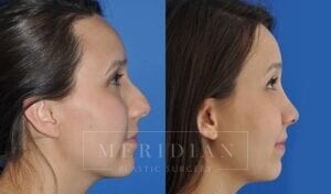 tjelmeland-meridian-austin-rhinoplasty-patient-3-1